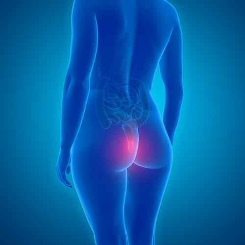 Skleroterapia hemoroidów