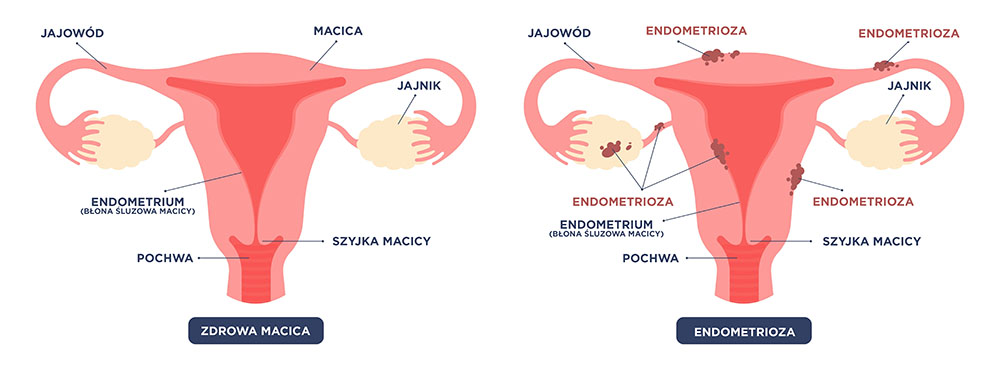 Co to endometrioza? Objawy endometriozy