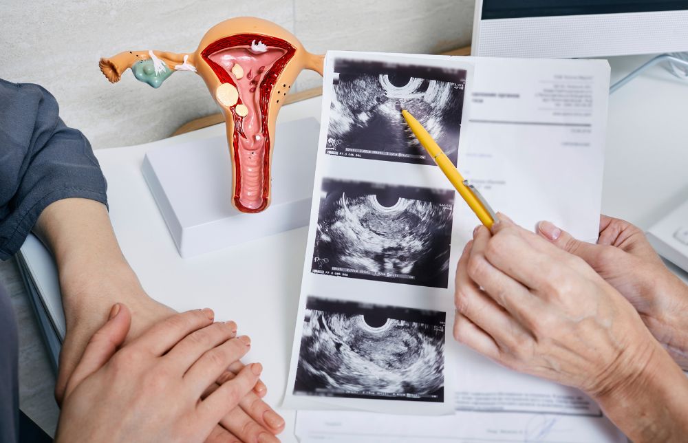 Objawy PCOS - USG jajnikówObjawy PCOS - USG jajników